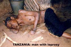 Old man with leprosy
